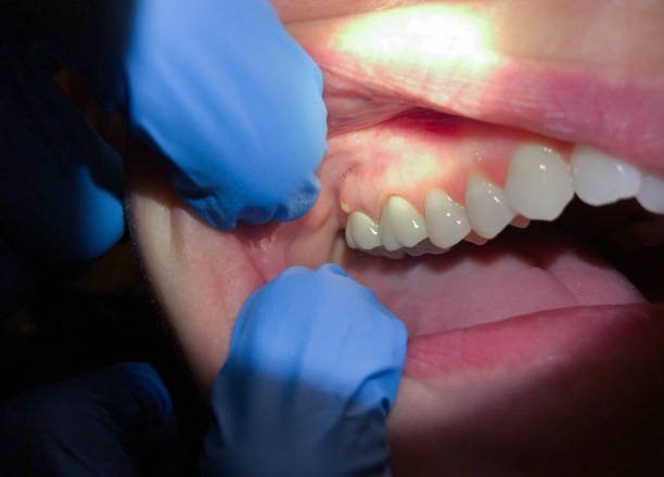 Best Dental Abscess Treatment in Helena Valley West Central, MT